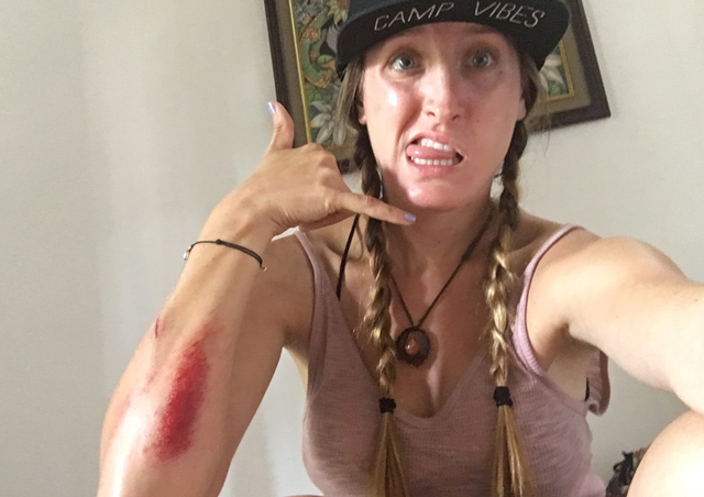 Aftermath of crashing a motorbike in Bali. There are way more graphic pictures, but I will spare the public.